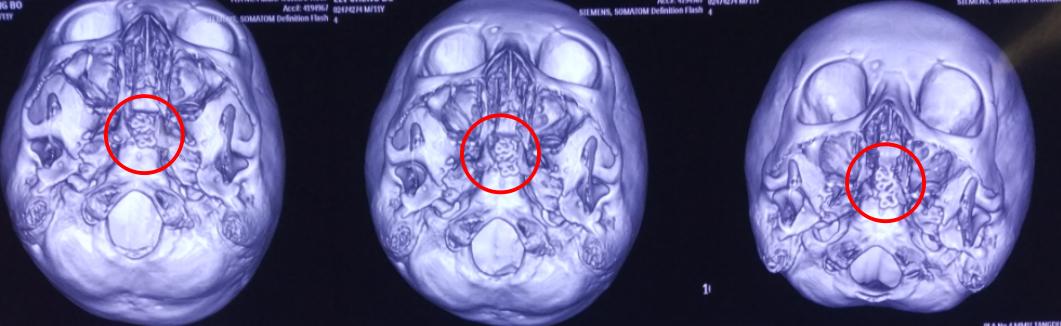 脑膜膨出手术是用什么修补的,蝶鞍区脑膜膨出手术怎么做