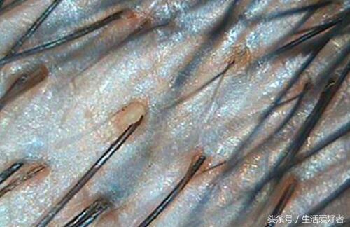 脂溢性脱发治疗初期脱发更严重,慢性脂溢性脱发用什么药