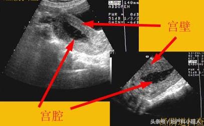 反复人工流产的危害出乎你的想象,人工流产的真实经历和感悟