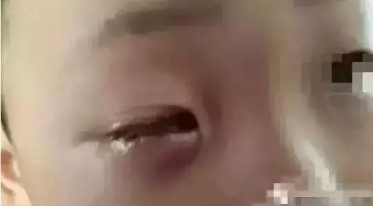 男童眼睛20分钟眼球被溶解,孩子眼球不小心被溶解视频谣言