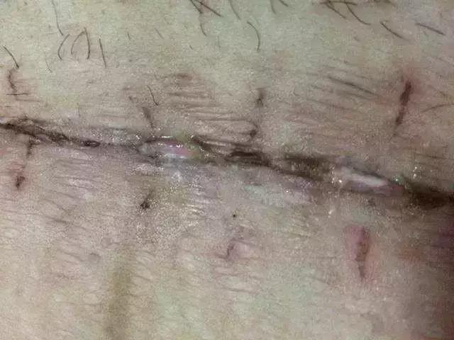 剖腹产后45天伤口有撕裂疼,剖腹产后20天肚子伤口裂开了