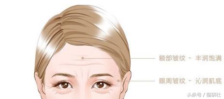 注射除皱案例,了解如何注射除皱