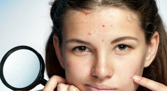 黑色痘印变成红褐色痘印,黑色痘印快速消除药膏