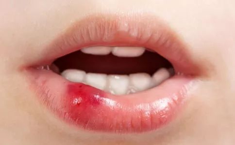 别让口腔难闻问题毁了你的颜值,别让你干裂的嘴影响你
