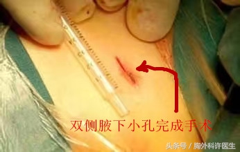 你说啥？手上多汗也要开刀？