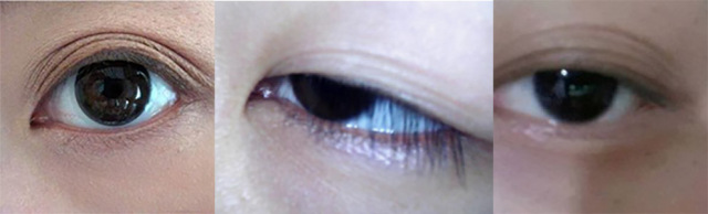 内双割双眼皮变成三眼皮怎么修复,双眼皮修复三次会有什么后果