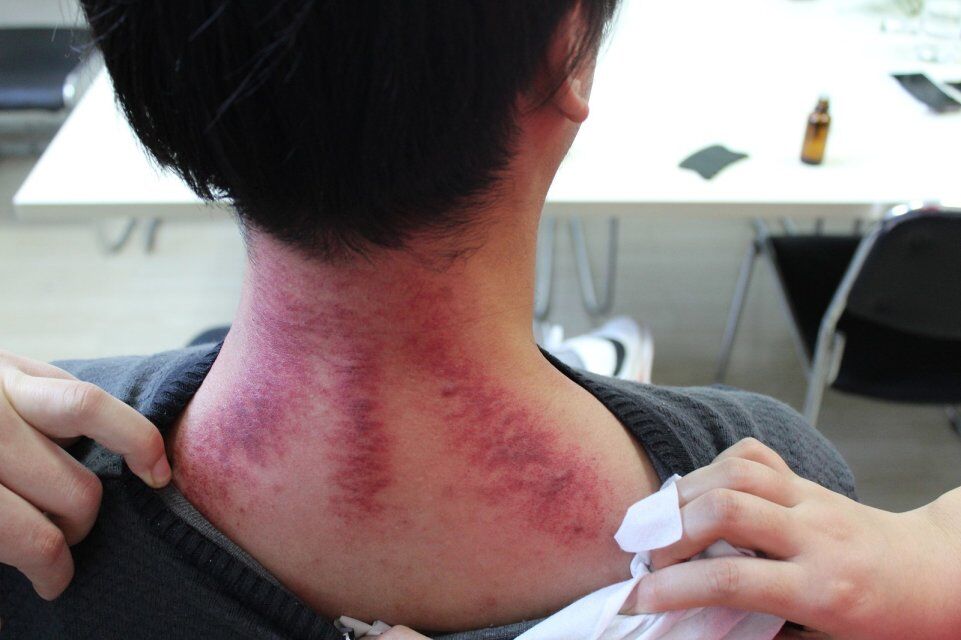 木易刮痧泥灸,木易刮痧