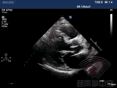 经典病例▏二尖瓣囊肿中竟然全是血液？