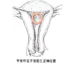 上环后有什么症状和危害,女性上环真对身体不好吗