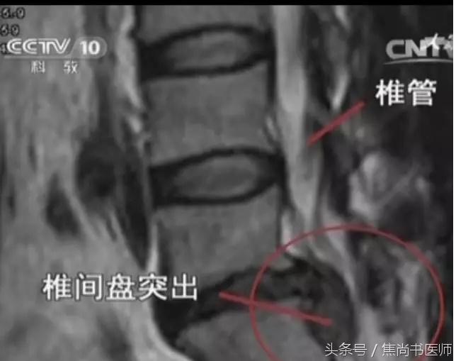 正骨法能不能治疗腰椎间盘突出,新医正骨可以治疗腰间盘突出症吗