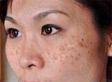 图解一分钟带你认清斑点分类，原来真的每个人都会长斑？