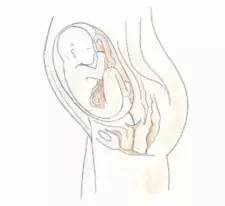 孕期笑多了会怎么样,孕期笑的时候漏尿