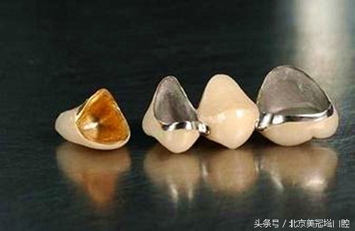 镶一口烤瓷牙到底好不好,镶的烤瓷牙有什么不习惯的吗