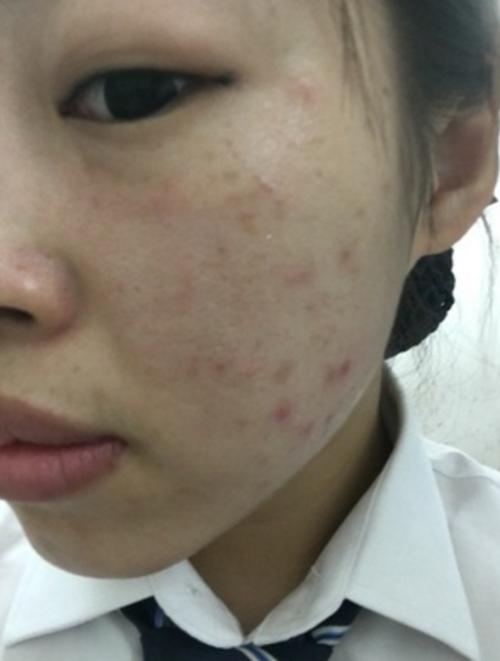 青春期怎么祛痘痘简单方法,青春痘快速祛痘方法