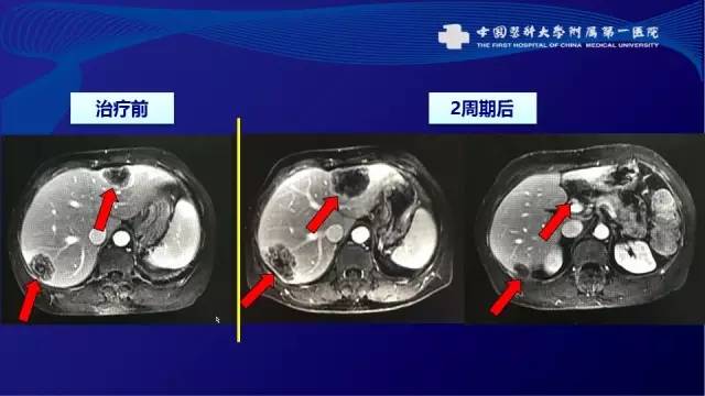 肠癌肝转移同时性和异时性,邢宝才治疗肠癌肝转移成功病例