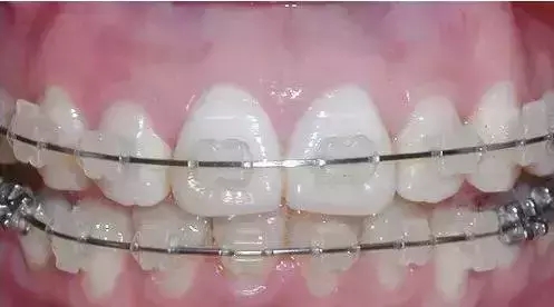 牙齿矫正前科普,牙齿矫正儿童动画科普