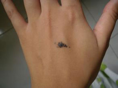 孙红雷曾说：得了黑痣赶紧点，千万别以为是好运和性感！真的吗？