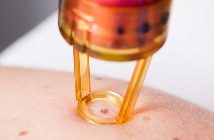 孙红雷曾说：得了黑痣赶紧点，千万别以为是好运和性感！真的吗？