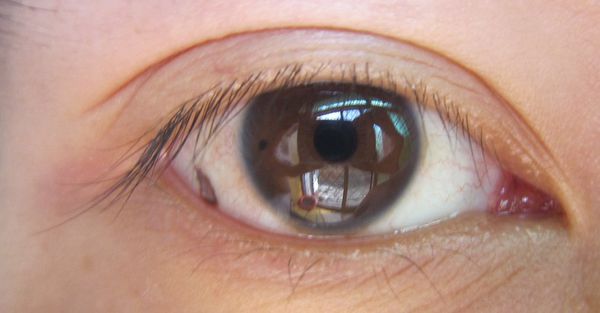 孙红雷曾说：得了黑痣赶紧点，千万别以为是好运和性感！真的吗？