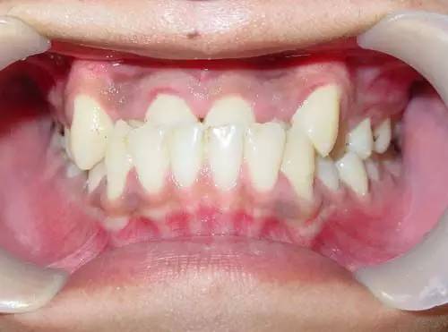 换牙注意事项以及禁忌,换牙期的十大禁忌