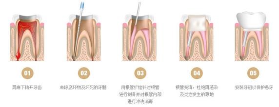 5岁宝宝做根管,5岁小孩做根管治疗全过程
