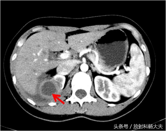 花季少女腰疼是什么原因,青春期女生为什么总是腿痛
