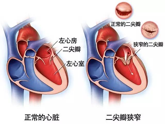 心脏二尖瓣出问题是怎么回事,心脏二尖瓣修复后应注意什么