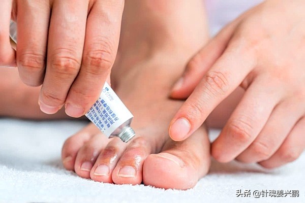 脚气真菌如何治才能根除,真菌脚气如何治才能根除