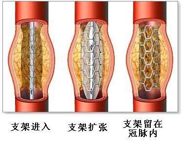 介入治疗你了解多少,了解介入手术