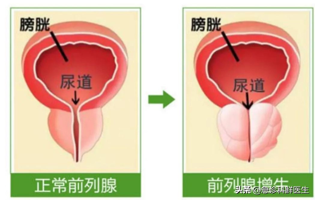得了前列腺增生怎么治疗会好,前列腺增生怎么治疗最快最有效