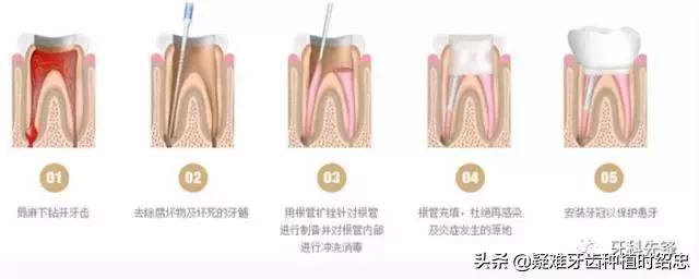 牙齿做根管治疗放的是什么药,牙没坏但是疼需要做根管治疗