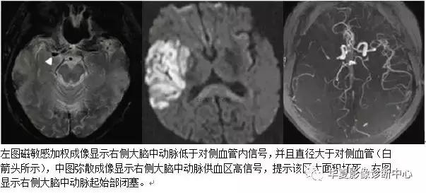 颅脑核磁影像解剖图谱,颅脑mr增强影像图片