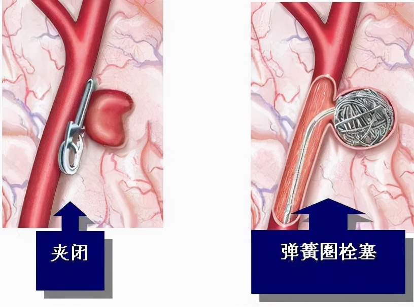 突然头疼要炸了怎么回事,睡觉突然头疼剧烈要炸了