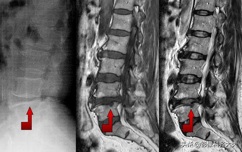 腰椎间盘突出的影像学诊断及治疗,腰椎间盘突出影像学课件