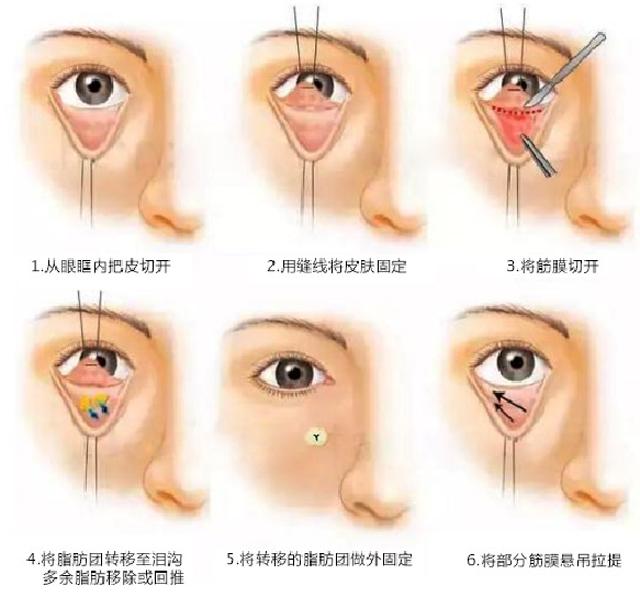 眼袋大很显老一个手法变卧蚕,卧蚕与眼袋别傻傻分不清楚