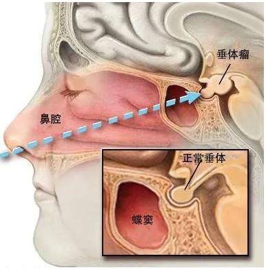 釜底抽薪的方剂,釜底抽薪治法