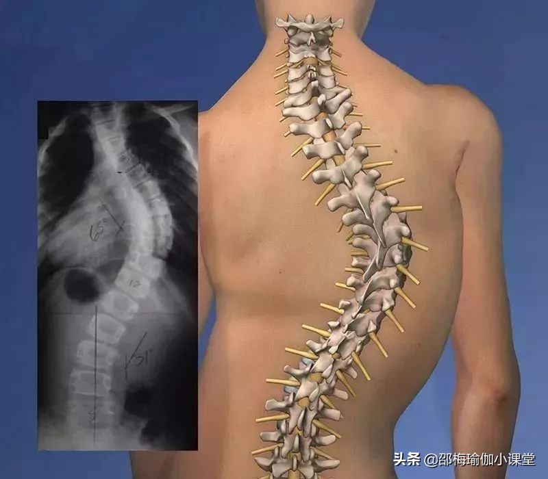 脊柱侧弯出现长短腿是多少度,脊柱侧弯长短腿怎么锻炼矫正视频