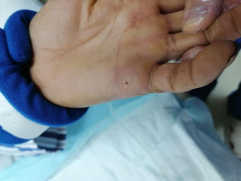 被带锈的铁器划一定要打破伤风吗,被带锈的铁器弄伤后多久打破伤风