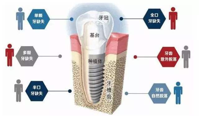 假牙吃到肚子里有什么坏处,把假牙吃到肚子的急救办法