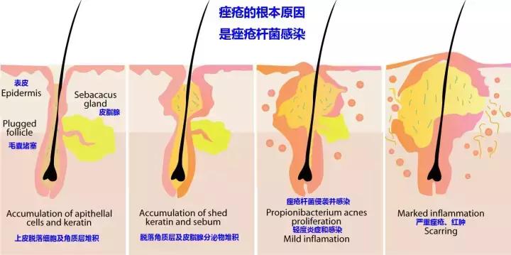 额头脸颊起小米粒痘痘怎么办,额头上的痘痘一直不消怎么办