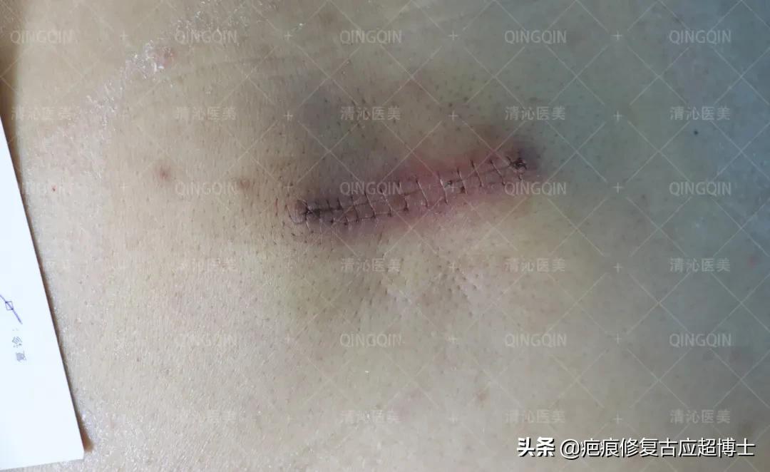 背部瘢痕疙瘩怎么去除,肩膀瘢痕疙瘩怎么食疗