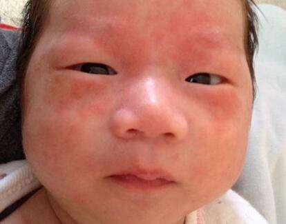 新生儿湿疹怎么护理最有效,新生儿屁股上有湿疹怎么护理