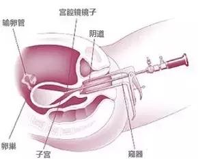 输卵管性不孕的最佳治疗方法,输卵管性不孕的中医治疗要点