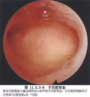 输卵管性不孕的最佳治疗方法,输卵管性不孕的中医治疗要点