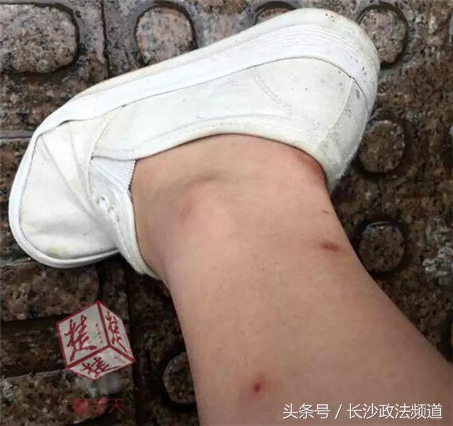 最近在家或外出都要小心它！一周内已有多人中招进了医院