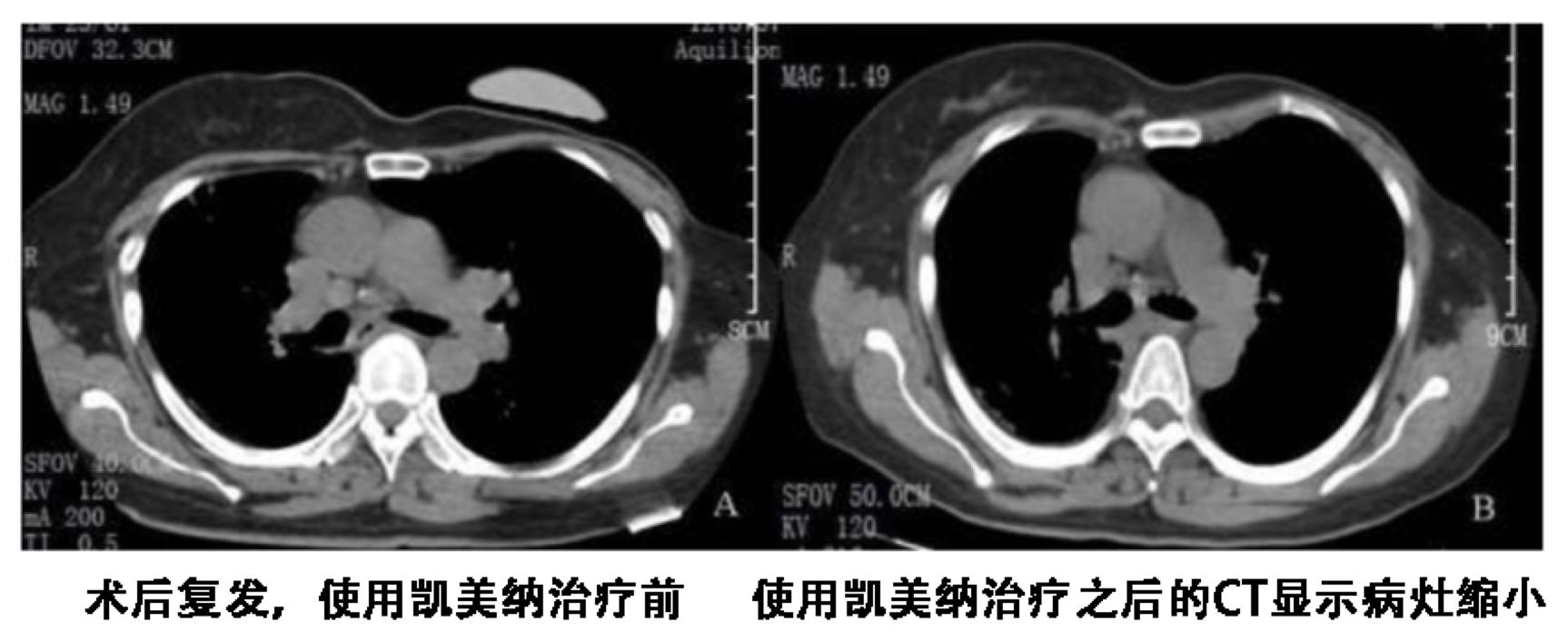 肺癌EGFR基因黄金突变的“反面”可以用靶向药品吗？