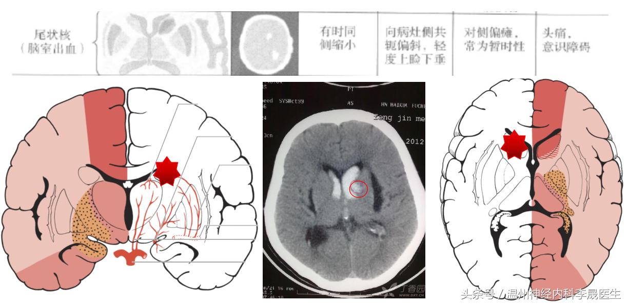 脑出血李医生,脑出血病例分析及答案