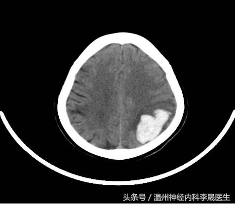 脑出血李医生,脑出血病例分析及答案