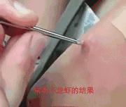 吃小龙虾从身体上取出虫子视频,女子体内取出一米虫子后续