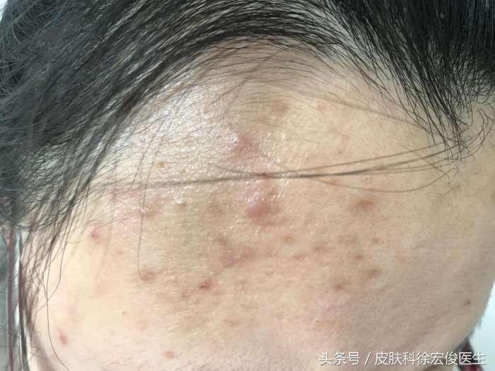 治疗青春痘有哪些医美,治疗青春痘的方法及注意事项